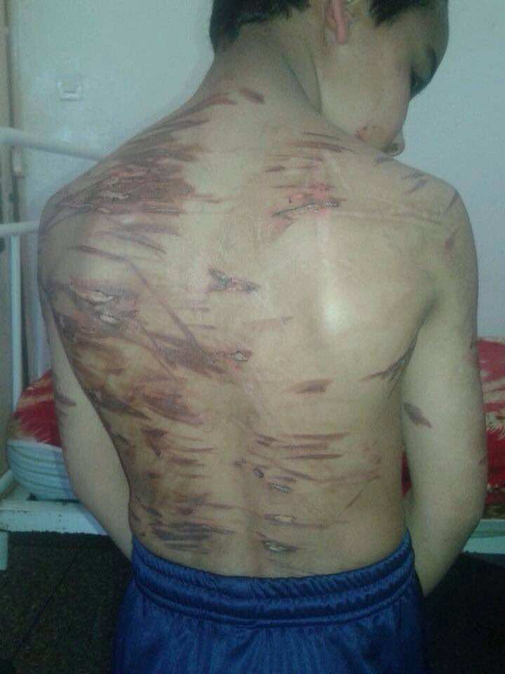 سنتان سجنا لامرأة عذبت ابن شقيقها بالكي 139 مرة!