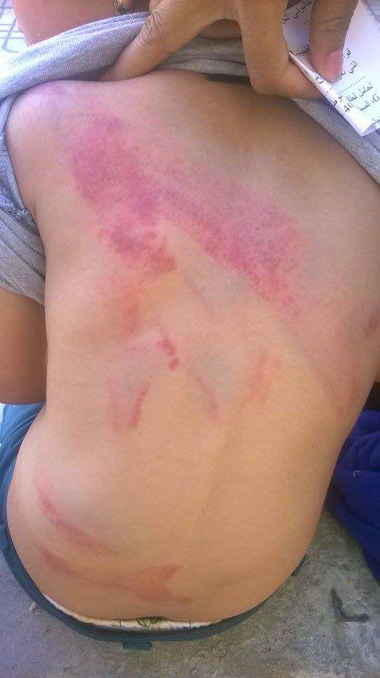3 سنوات حبسا نافذا لسيدة عذبت طفل شقيقها بسطات