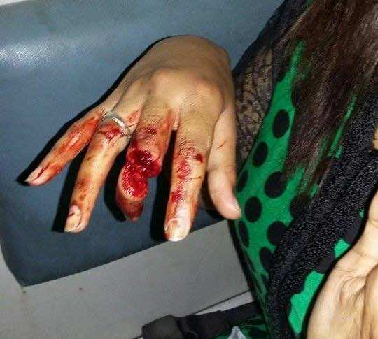 "مقرقب" يهاجم فتاة داخل منزلها ويبتر أحد أصابع يدها بسيف -صور