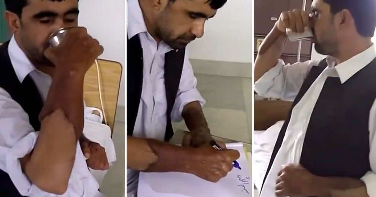 نجاح عملية زرع ذراع رجل مسيحي هندي لمسلم أفغاني -فيديو