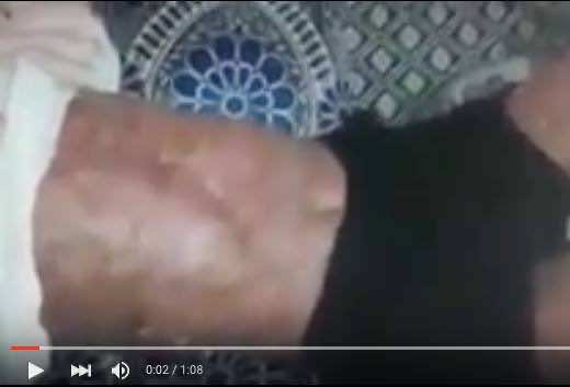 قاسي..سرطان دم يفتك بجسم رجل أربعيني وابنته تناشد المحسنين"فيديو"