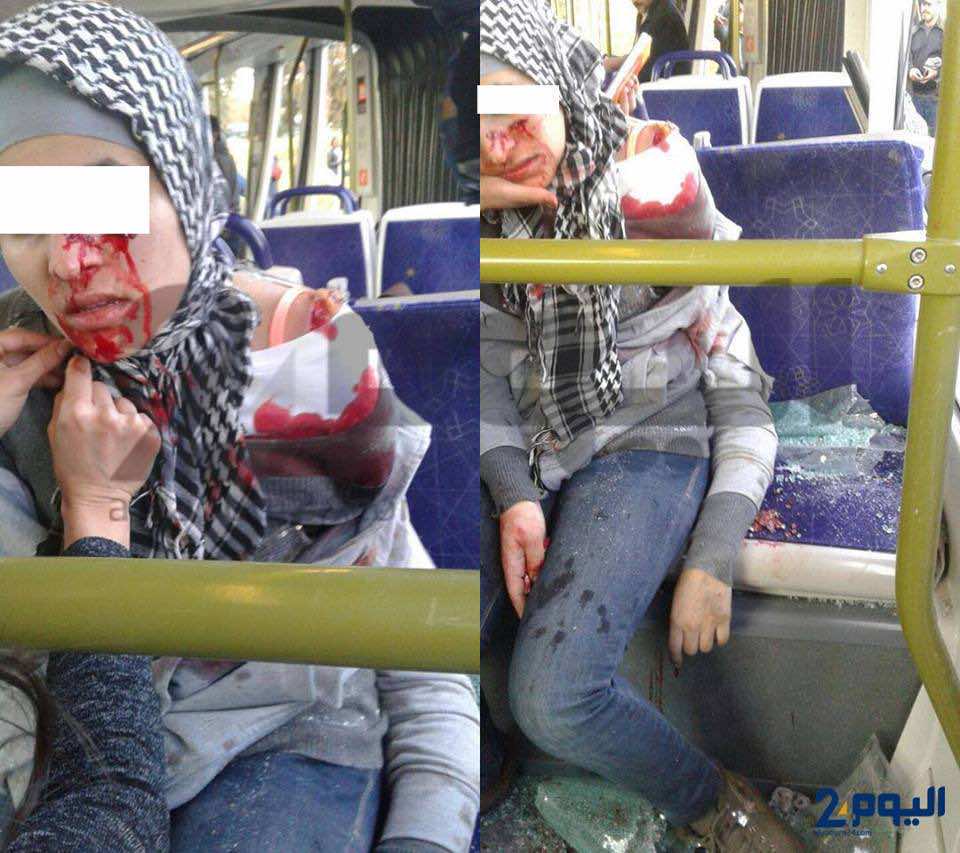 ضحية حادث "الترامواي" تُغادر الإنعاش وحالتها النفسية مُتدهورة