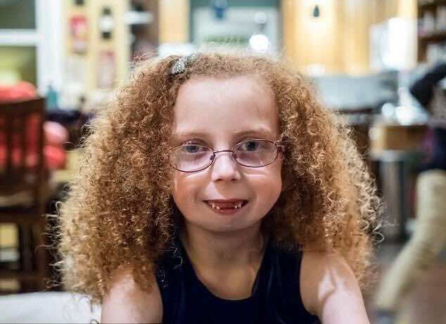 طفلة تخضع لـ 11 عملية لإعادة بناء وجهها بعد ولادتها بدون فك-صور
