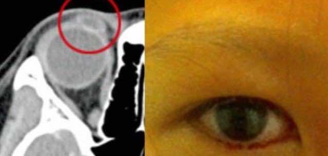 فتاة عمرها ١١ سنة وتذرف بدل الدمع دماً من عينها!