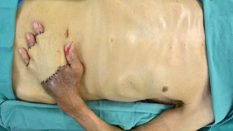 عملية جراحية غريبة لإنقاذ يد رجل من البتر -صور