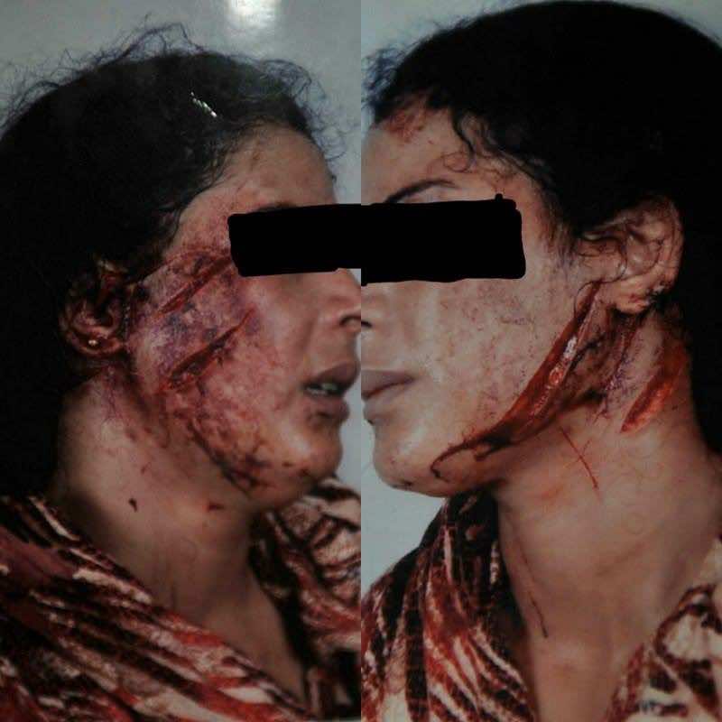 زوج "يشرمل" وجه زوجته بالسكين ويهرب!- صور صادمة