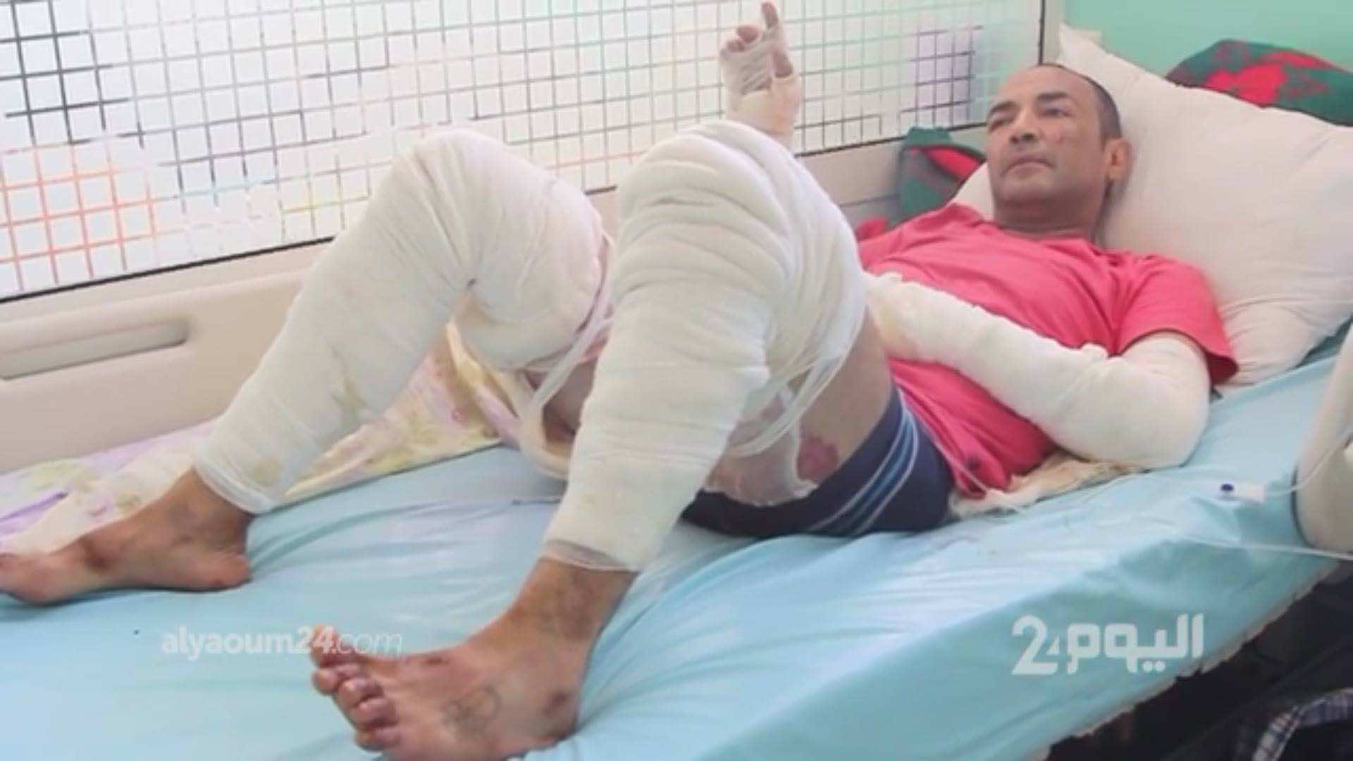 القصة الكاملة للعاشق الذي خاط فمه وأضرم النار في جسده - فيديو