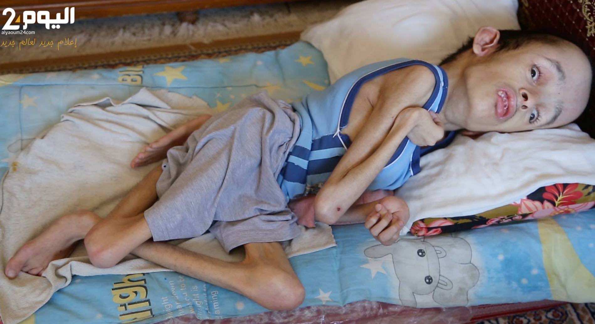 صلاح.. شاب عمره 24 سنة ولا يزال بهيئة رضيع!! -فيديو مؤثر