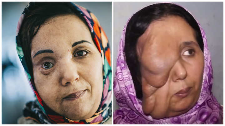 المغربية سميرة بعد المعجزة الإسبانية التي أعادت إليها الحياة