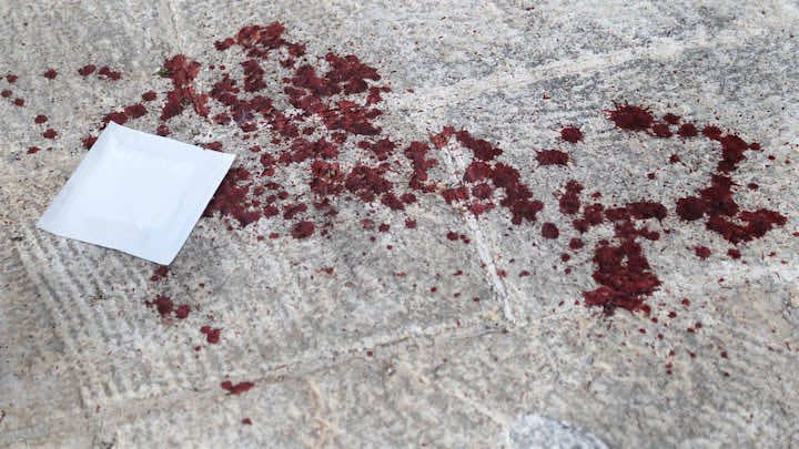 24 "غرزة" في وجهها ويدها بعد دفاعها عن شقيقتها بالبيضاء