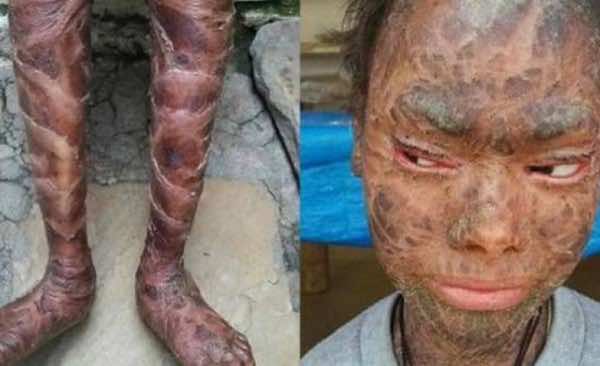 مثير.. فتاة مثل "الأفعى" تغير جلدها كل 6 أسابيع