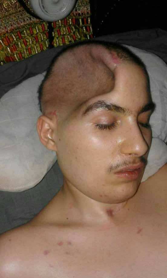 المهدي.. قصة شاب هشم حادث سير جمجمته يوجه نداء استغاثة للوردي