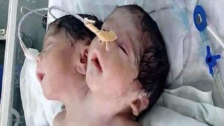 نادر.. ولادة طفل برأسين -فيديو
