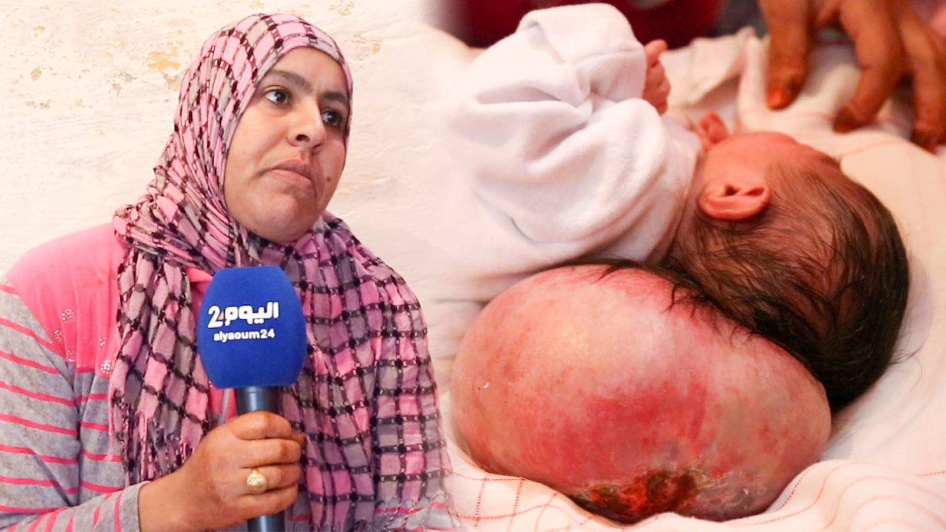 ملاك..طفلة ولدت "برأسين" بالرباط وحياتها متوقفة على 18 مليون- فيديو