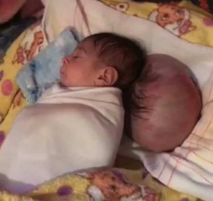الرضيعة التي ولدت برأسين..أحد المحسنين يتكفل بالعملية- فيديو