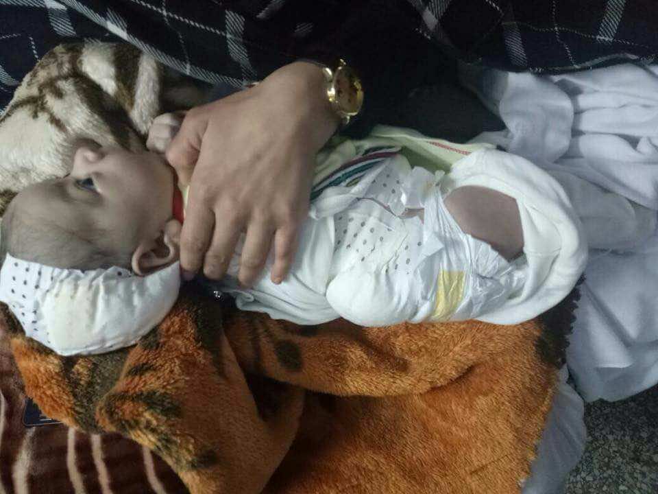 مرض نادر في الرأس يهدد رضيعا بالموت في أكادير- فيديو وصور