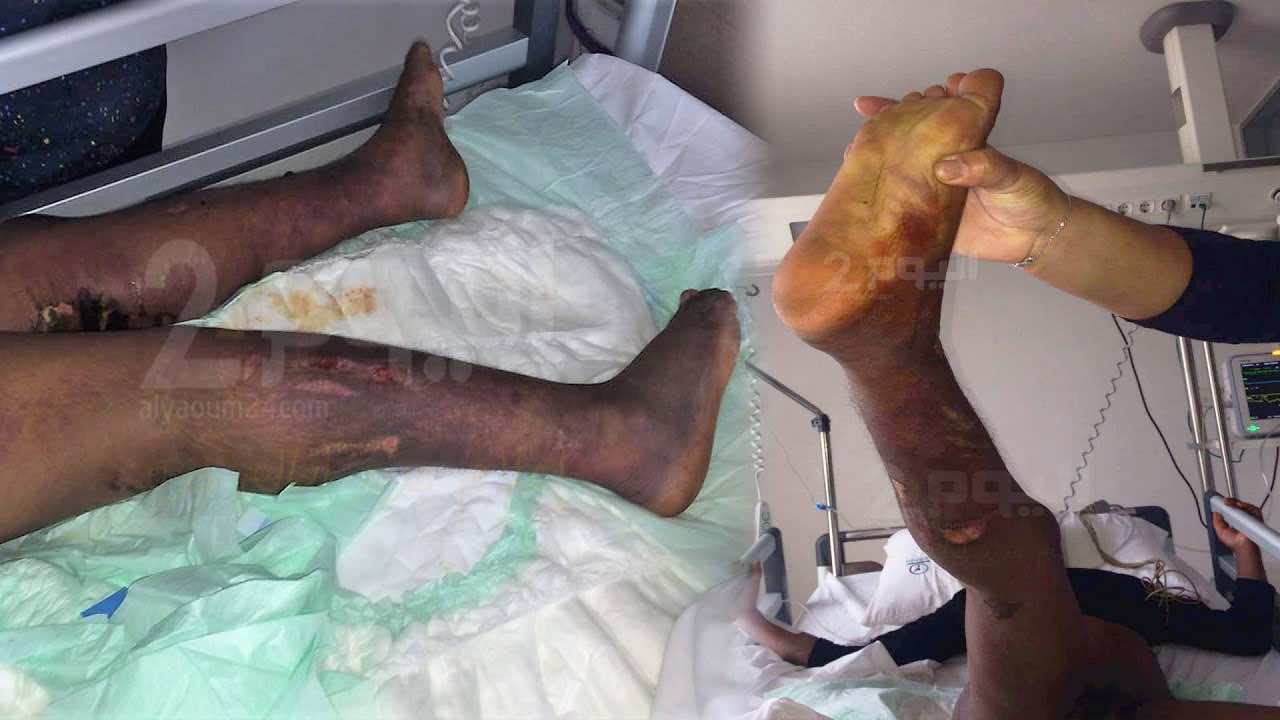 تصريحات مثيرة في قضية الخادمة "لطيفة".."سرقة" وكي للعلاج!- فيديو