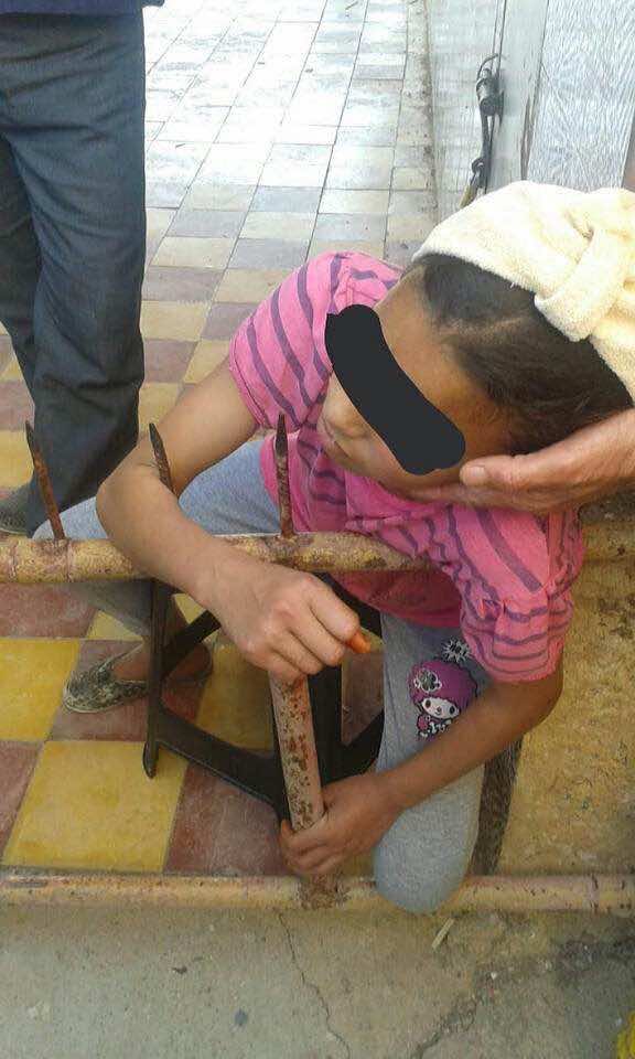 قضبان حديدية تخترق جسد طفلة..ومدير المستشفى: نجت بأعجوبة من الموت!