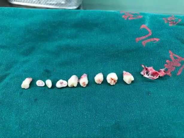 أطباء يعثرون على أسنان تنمو داخل دماغ طفل - صور
