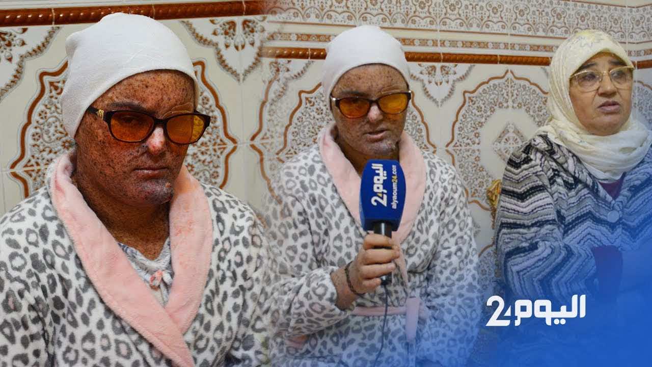 حالة تدمي القلب.. شابة من "أطفال القمر" أزيلت عينها بسبب ورم تناشد المغاربة المساعدة - فيديو