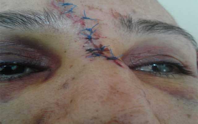 صحن يتسبب في جرح غائر لسيدة في البيضاء..وتحقيق لمعرفة مدى تقصير الأمن