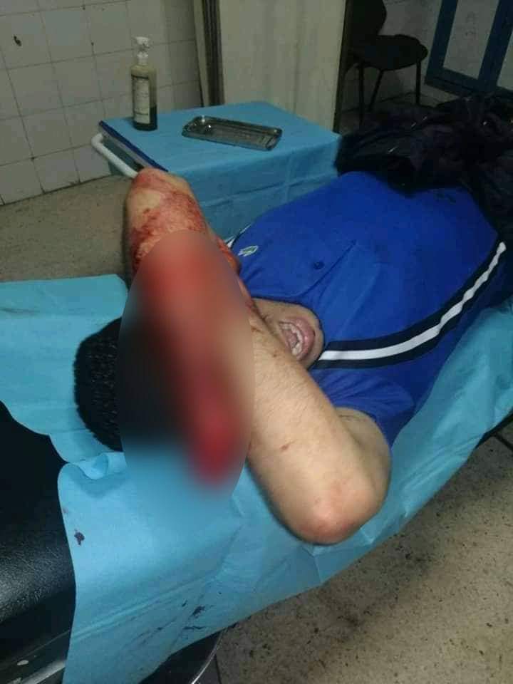 بعد بتر يد شخص في أكادير .. فاعلون يطالبون بإحداث دائرة أمنية في منطقة تدارت أنزا - صور