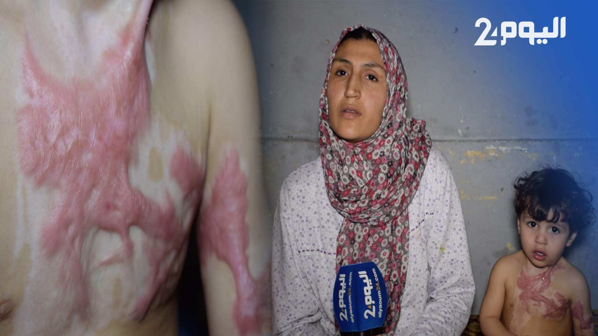 مأساة أسرة تعيش في مرآب..الأم: لا مطبخ ولا غرف إلى ان احترق ابني - فيديو