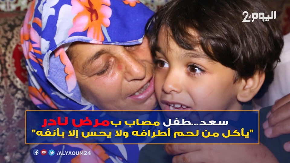 مؤلم.. طفل مصاب بمرض نادر "يأكل من لحم أطرافه ولا يُحس إلا بأنفه"-فيديو