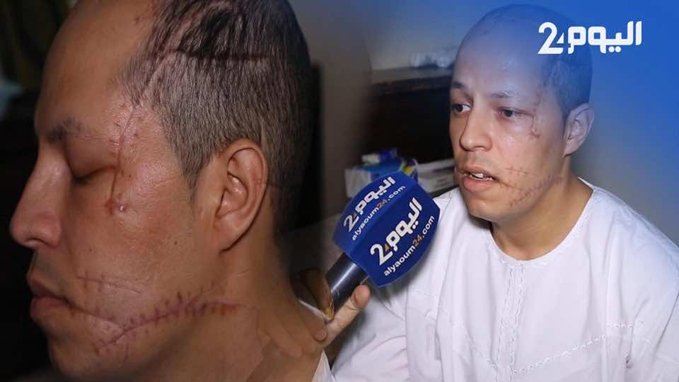 ضحية كريساج في القنيطرة: "ضربوني نهار العيد وحتى حد مغادي يخدمني وأنا بهذه الحالة"-فيديو