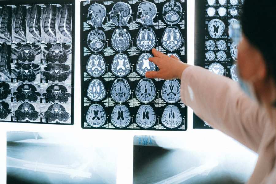 مرض الصرع يصيب أكثر من 400 ألف شخص في المغرب