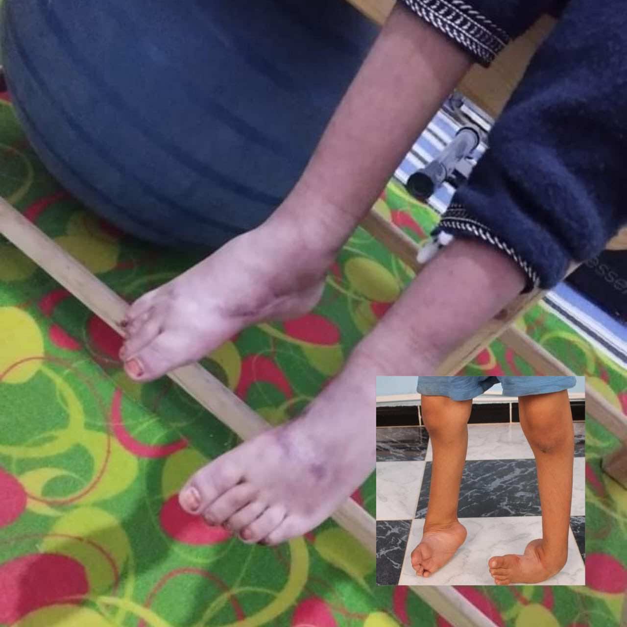 مراد... قصة طفل تعرض لالتفاف قدميه ووالده: ابني في حاجة لحذاء طبي